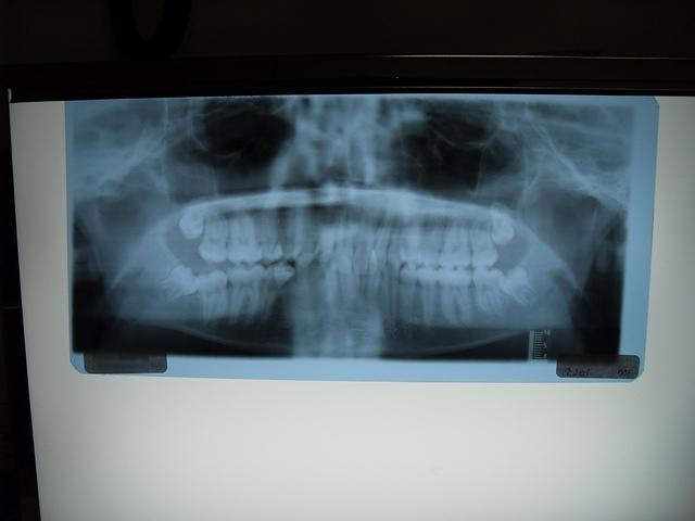 Xray of Four impacted teeth